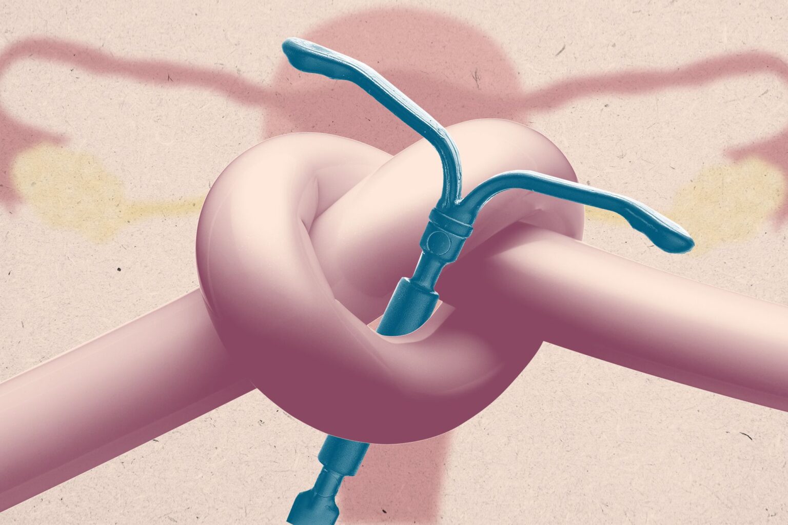 Certains DIU peuvent mieux prévenir la grossesse que la ligature des trompes