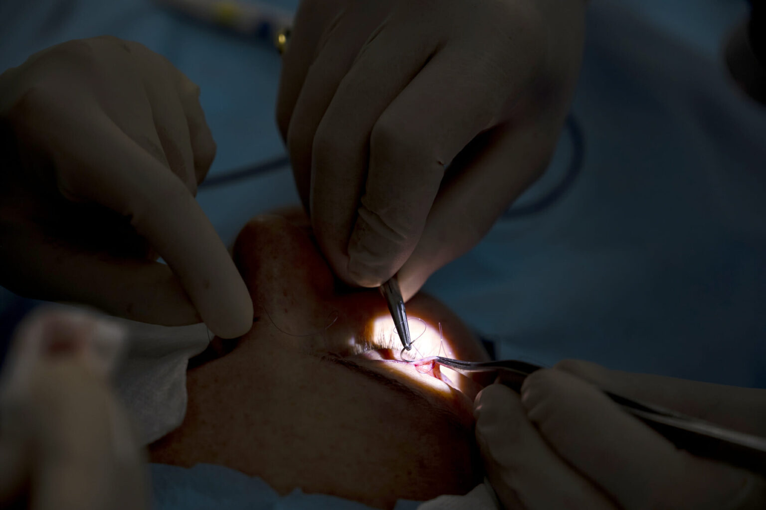 Le test des clips vasculaires prédit les changements faciaux après une blépharoplastie
