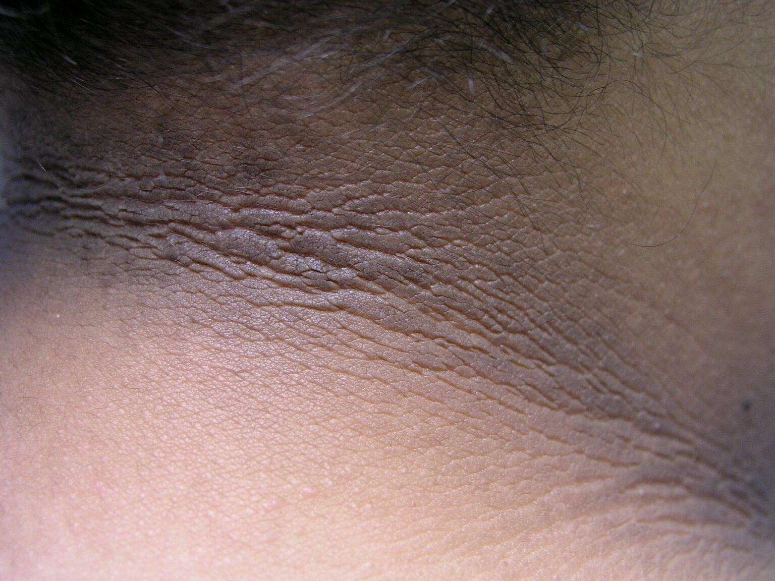 Traitement combiné avec des peelings chimiques pour Acanthosis Nigricans Traitement combiné avec des peelings chimiques pour Acanthosis Nigricans