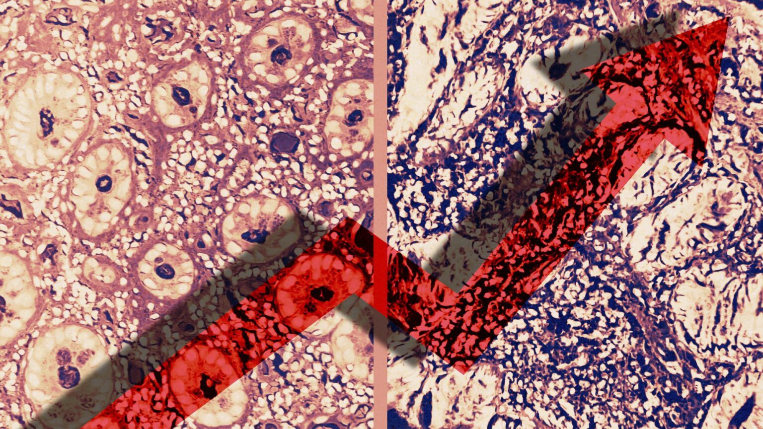 Une nouvelle étude montre une augmentation des diagnostics de cancer du sein et colorectal à un stade avancé pendant la pandémie de COVID-19 Une nouvelle étude montre une augmentation des diagnostics de cancer du sein et colorectal à un stade avancé pendant la pandémie de COVID-19