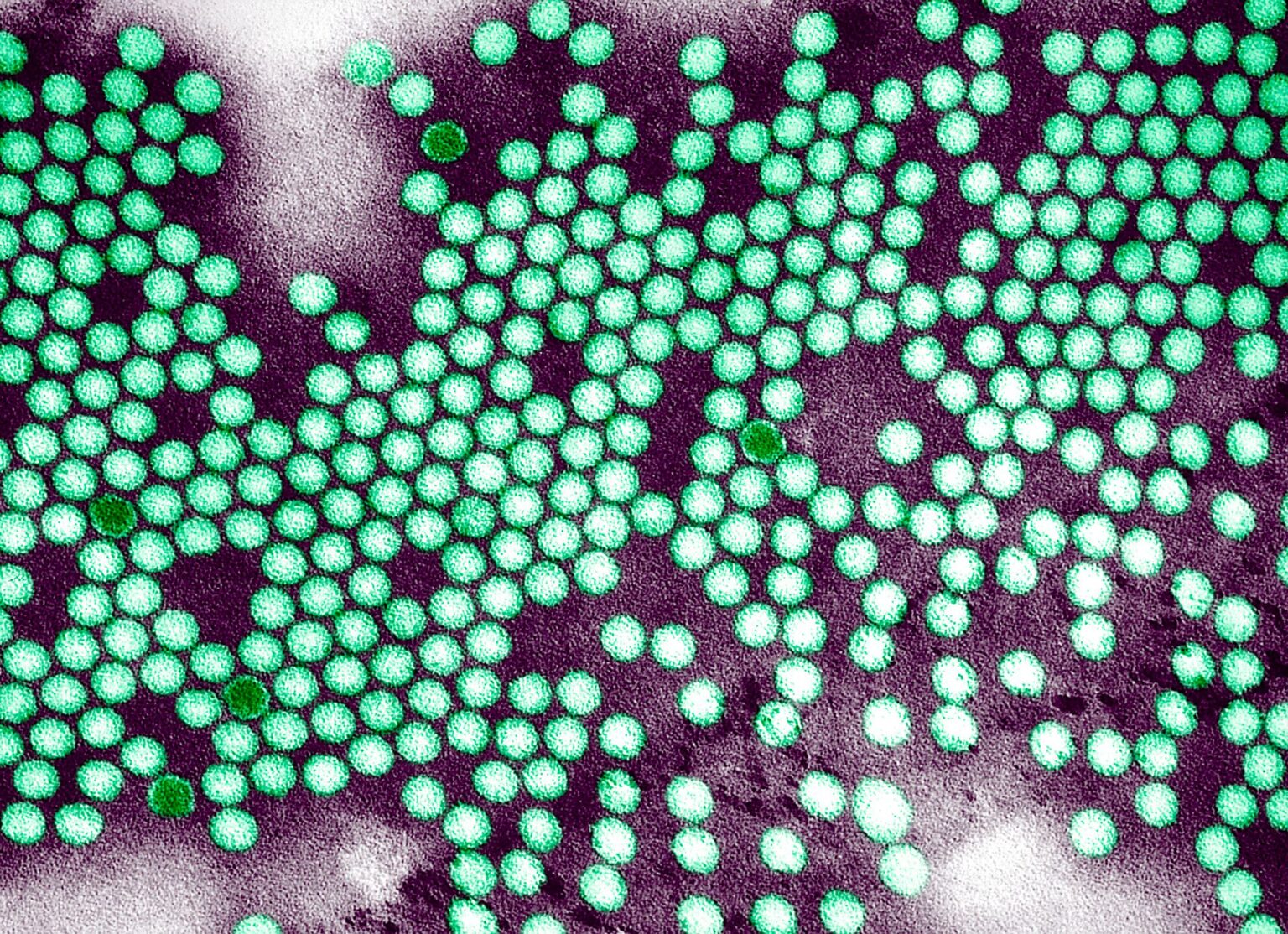 Poliomyélite dérivée d'un vaccin : ce qu'il faut savoir après l'identification du premier cas en près d'une décennie à New York