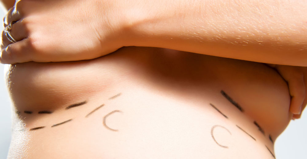 Les quatre S lorsque l'on envisage une augmentation mammaire