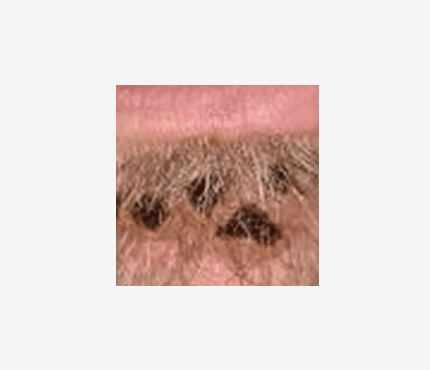 éruption de monkeypox