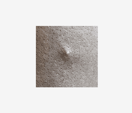 éruption de monkeypox