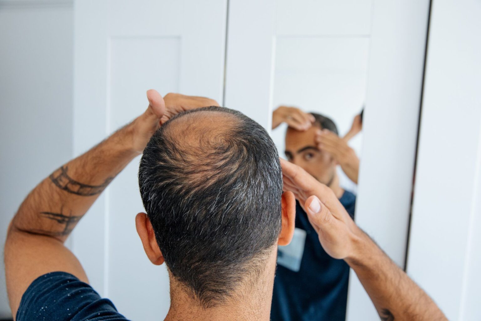 Minoxidil oral pour la perte de cheveux : ce qu'il faut savoir sur l'utilisation hors AMM du médicament