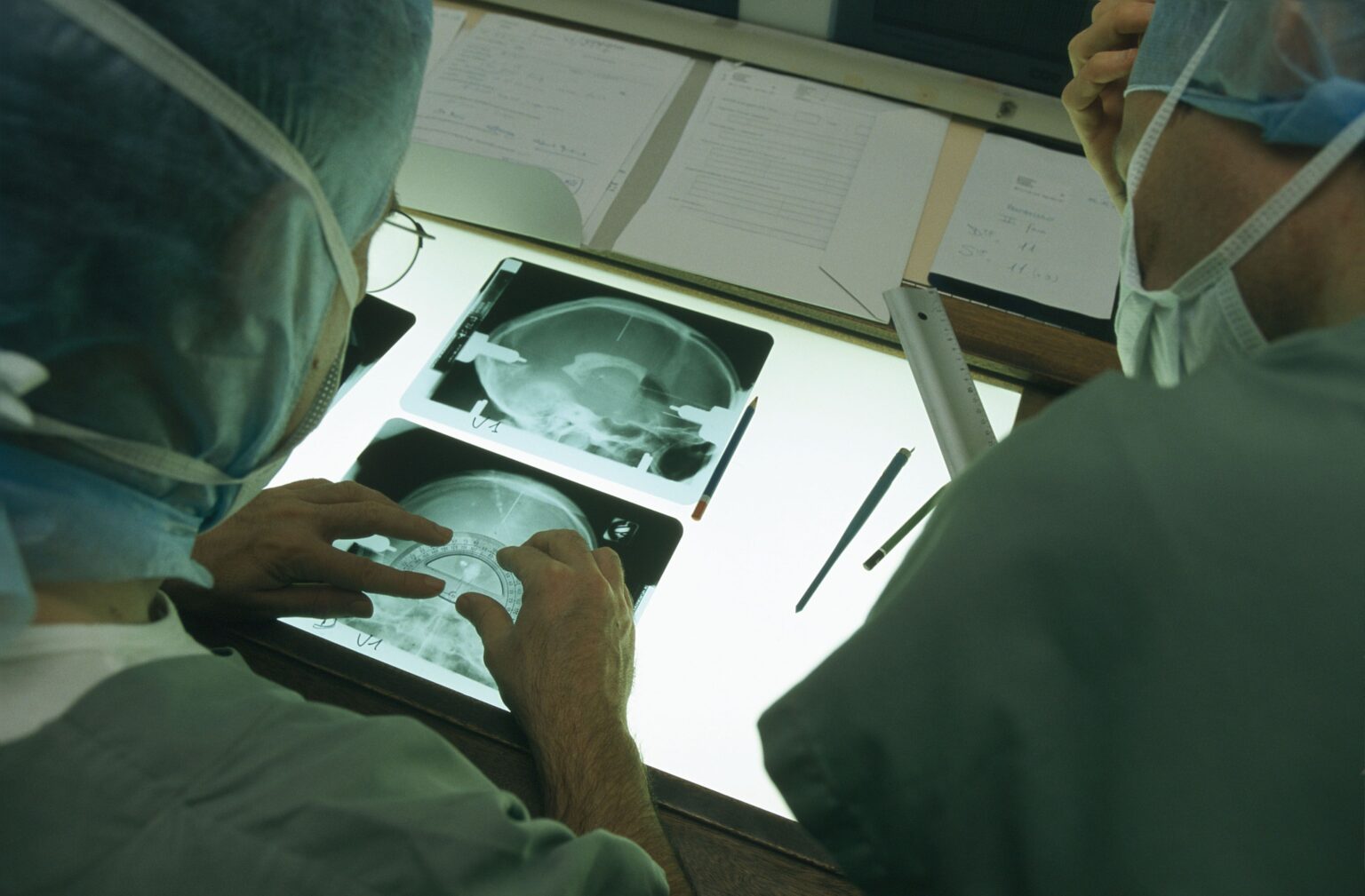 Qu’est-ce que la stimulation cérébrale profonde ? Comment le traitement peut aider le TOC sévère Qu'est-ce que la stimulation cérébrale profonde ? Comment le traitement peut aider le TOC sévère