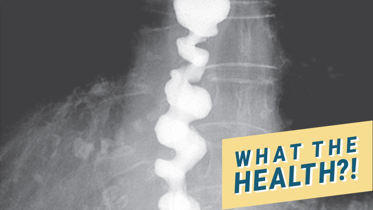 Qu'est-ce que l'œsophage en tire-bouchon?