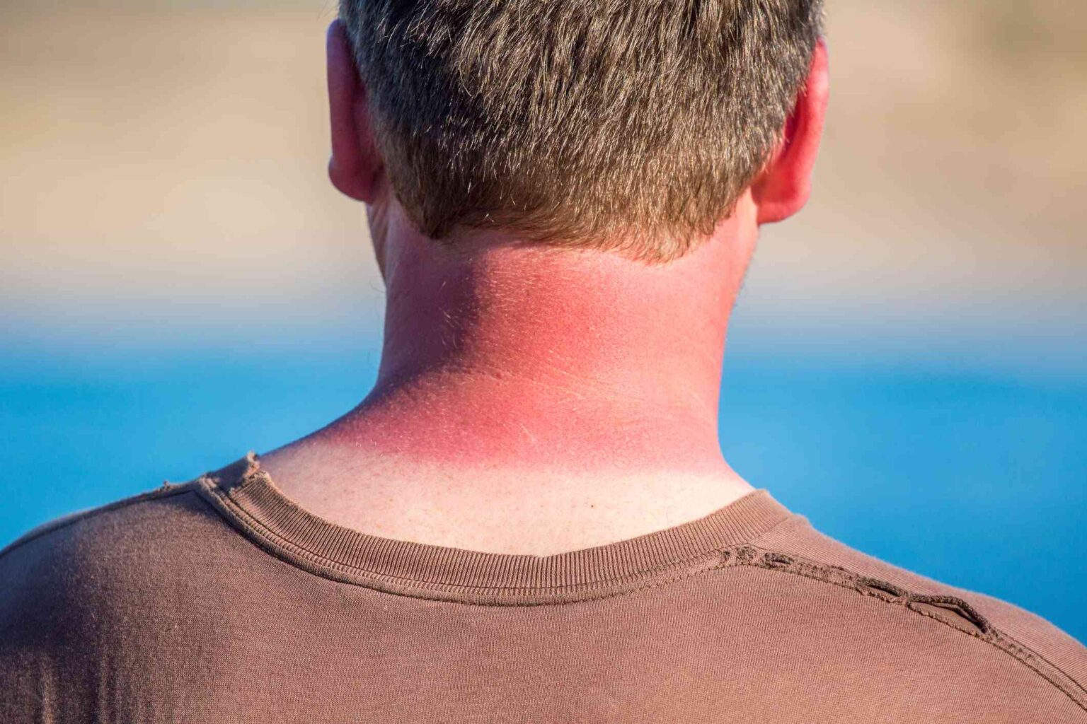 Les hommes sont plus susceptibles de mourir d'un mélanome, mais pourquoi ?