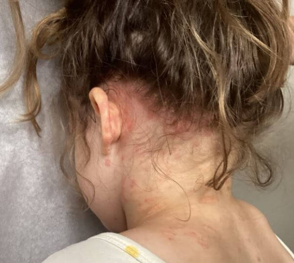 DermDx : enfant présentant une éruption cutanée le long de la racine des cheveux DermDx : enfant présentant une éruption cutanée le long de la racine des cheveux
