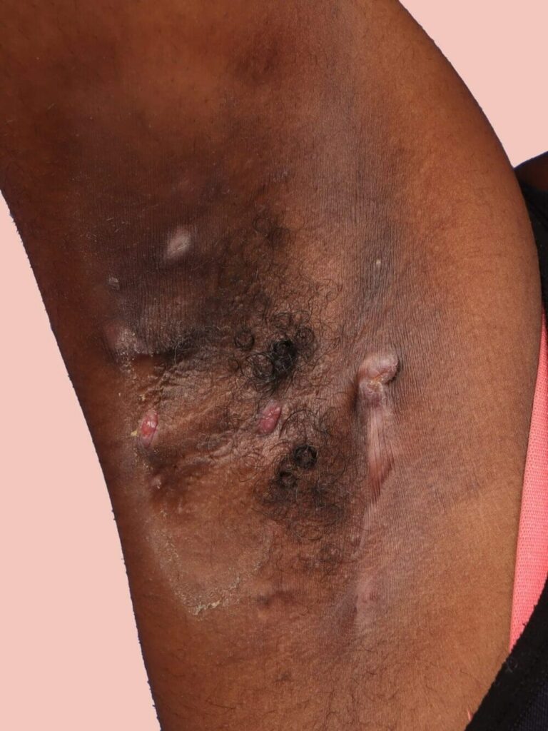Hidradenitis suppurativa early recognition and treatment