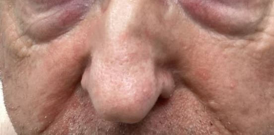 DermDx : éruption cutanée dans les sillons nasogéniens