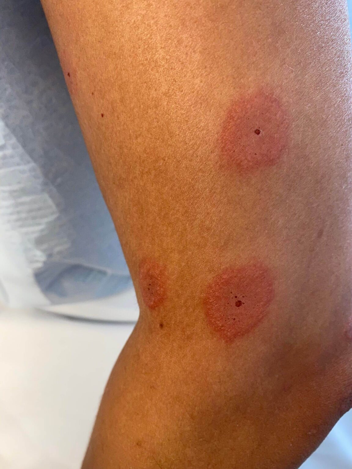 Plaques érythémateuses œdémateuses sur le visage et les extrémités Plaques érythémateuses œdémateuses sur le visage et les extrémités