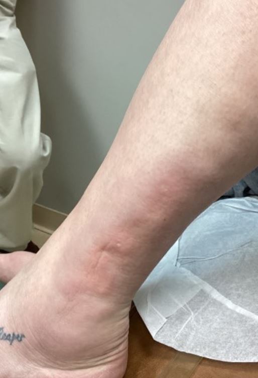 DermDx : Nodules érythémateux douloureux fermes