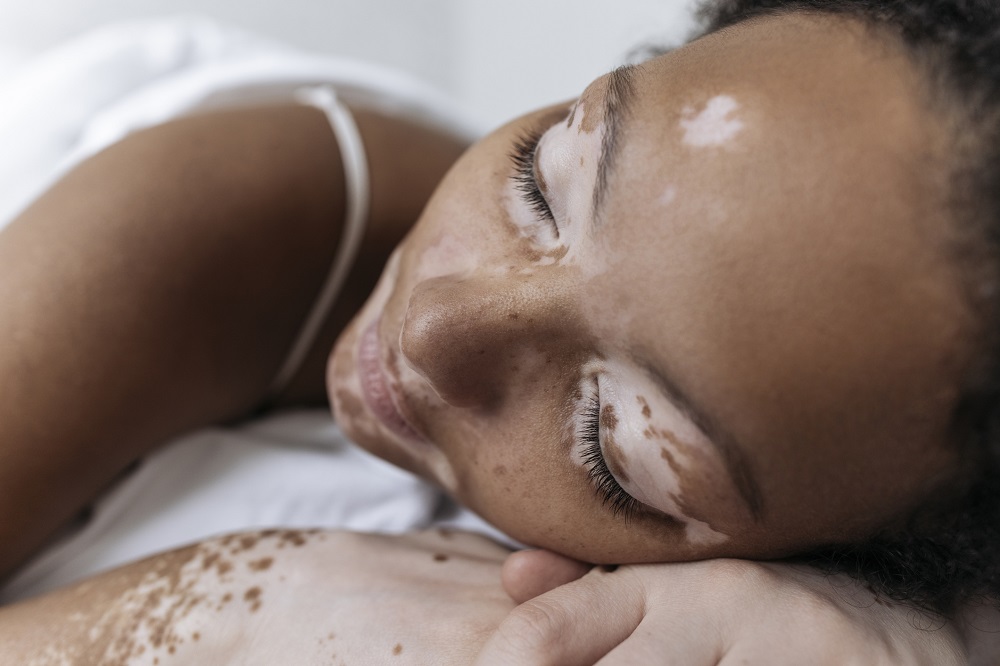 Le groupe de travail sur le vitiligo publie des recommandations consensuelles sur le diagnostic et la prise en charge woman-with-vitiligo-lying-down