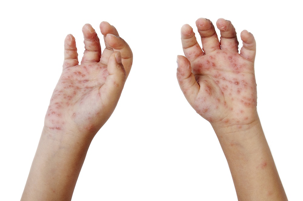 Traiter le psoriasis pustuleux généralisé juvénile réfractaire avec des produits biologiques