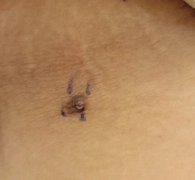 DermDx : Papule sur une plaque brune papillomateuse DermDx : Papule sur une plaque brune papillomateuse