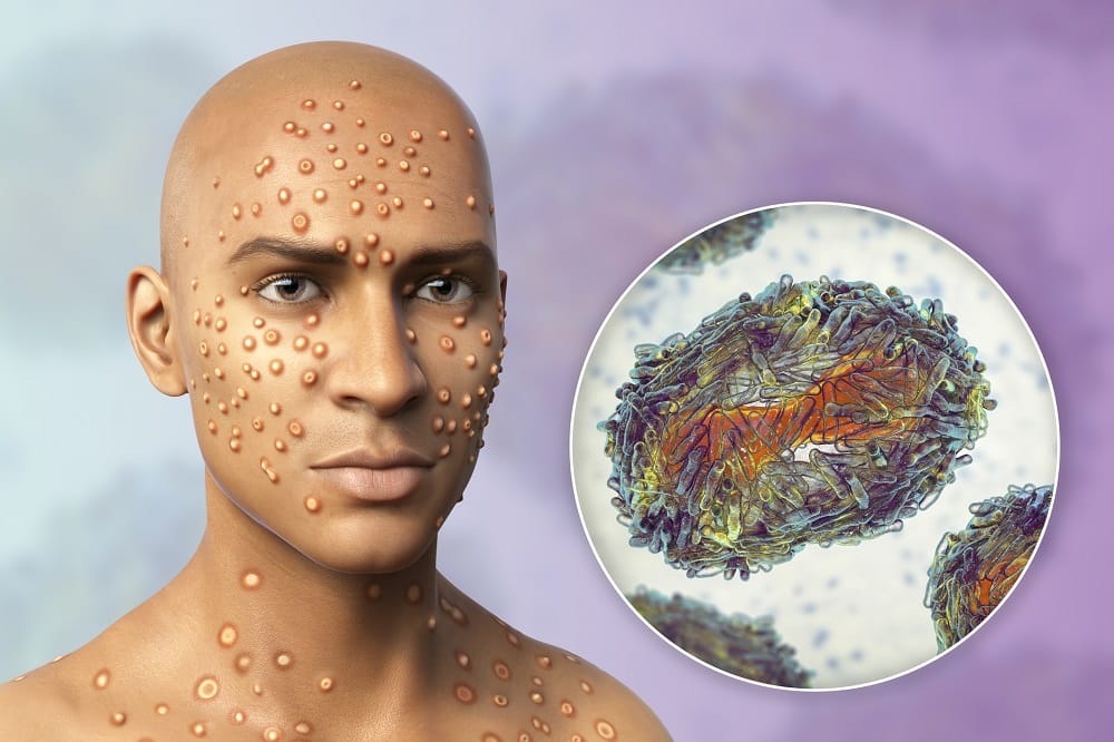 Les symptômes neurologiques de la maladie Mpox méritent une attention particulière mpox-illustration-facial-skin-rash-and-illustrated-virus-cell