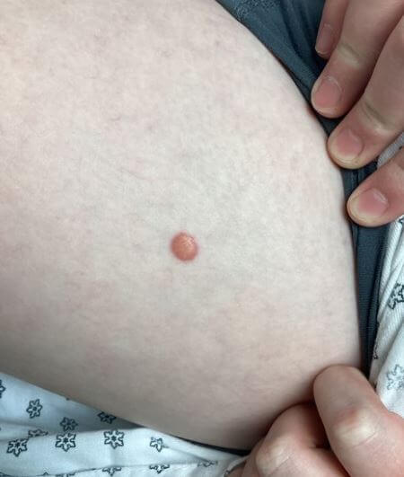 Derm Dx : Nodule rougeâtre sur la cuisse
