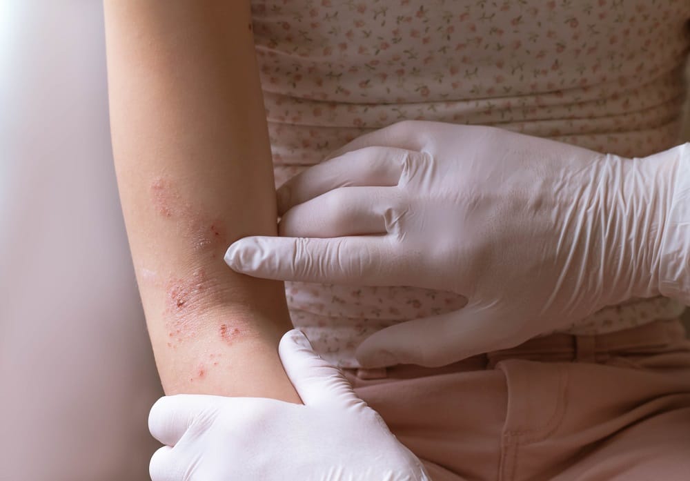 Le groupe de travail conjoint AAAAI/ACAAI publie des mises à jour des lignes directrices pour la gestion de la dermatite atopique Physician-examining-patient-atopic-dermatitis-on-arm