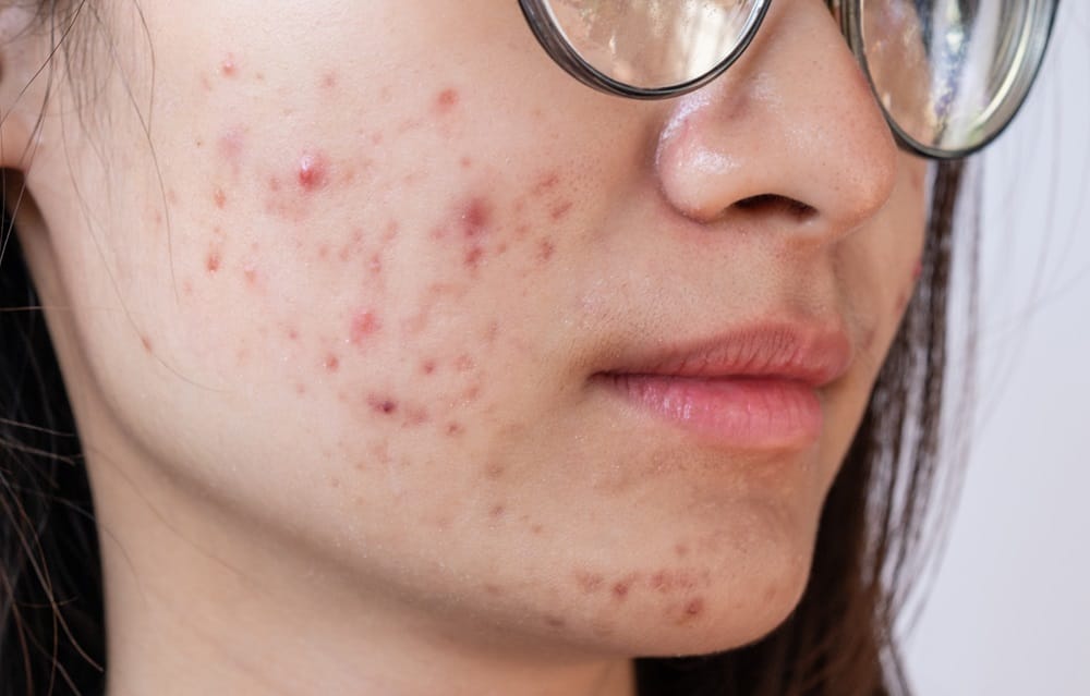 AAD publie de nouvelles lignes directrices pour la prise en charge clinique de l'acné vulgaire Side-profile-of-woman-with-acne