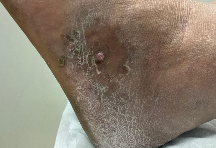 DermDx : plaques et nodules sur pied
