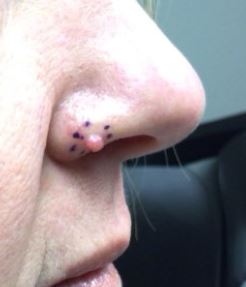 DermDx : Papule sur la narine droite