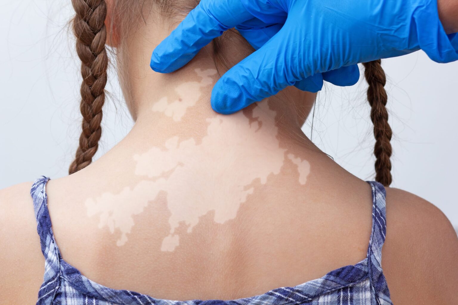 child's-back-with-vitiligo