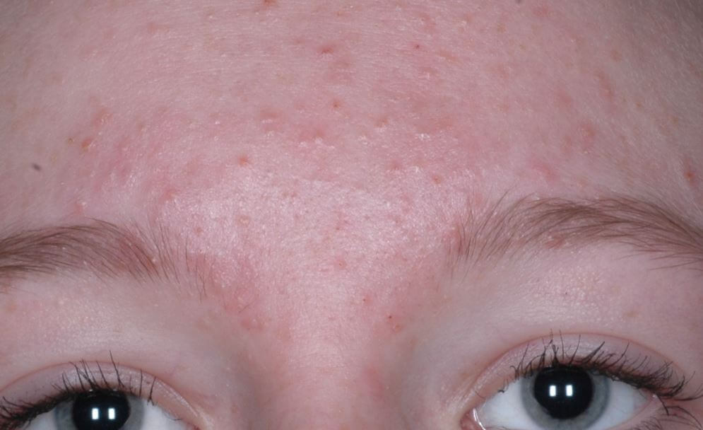 DermDx : Papules blanchâtres sur le front