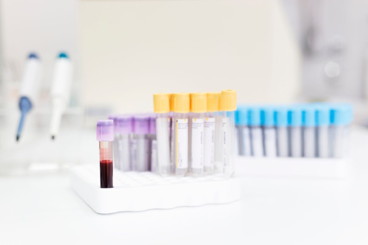 Nouvelle étude : un simple test sanguin pourrait être le moyen le plus précis de détecter la maladie d'Alzheimer