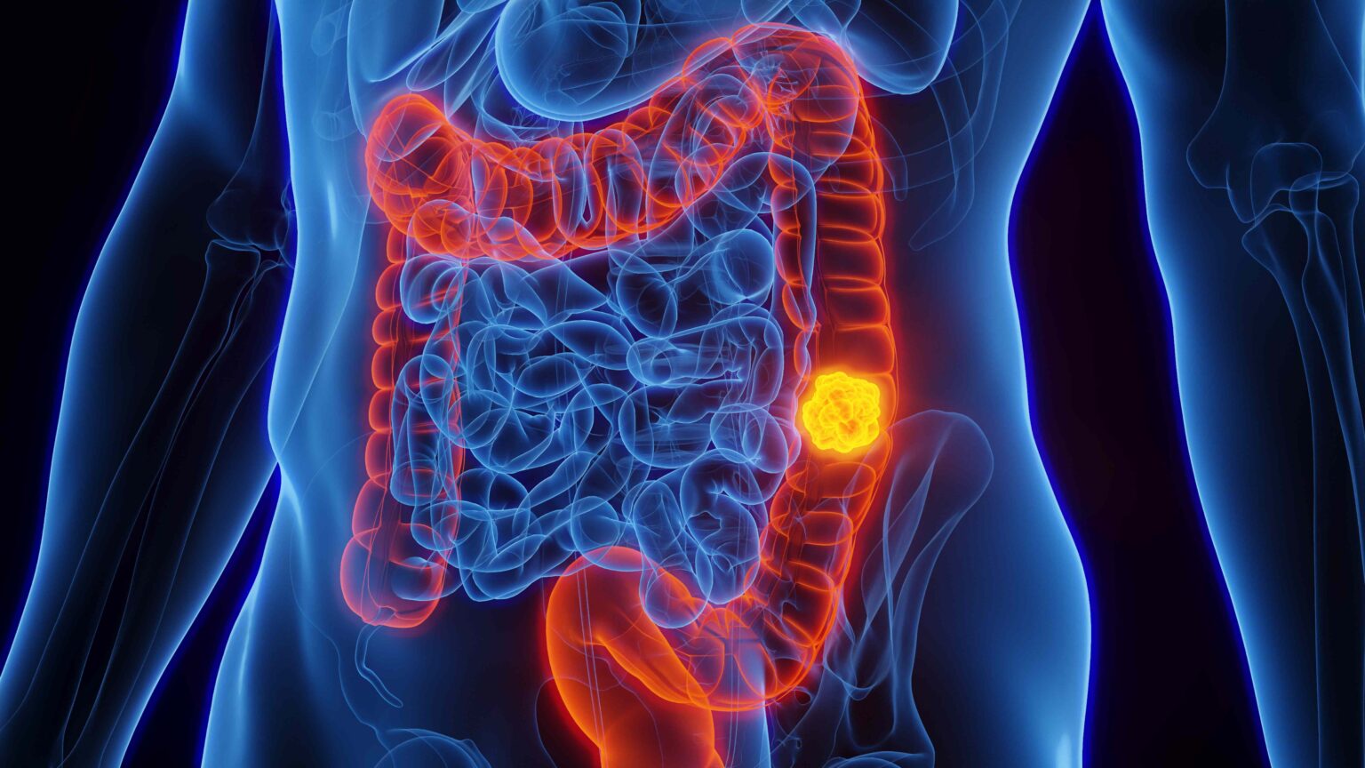 Le cancer colorectal est désormais la principale cause de décès par cancer chez les personnes de moins de 50 ans : ce que vous devez savoir Le cancer colorectal est désormais la principale cause de décès par cancer chez les personnes de moins de 50 ans : ce que vous devez savoir